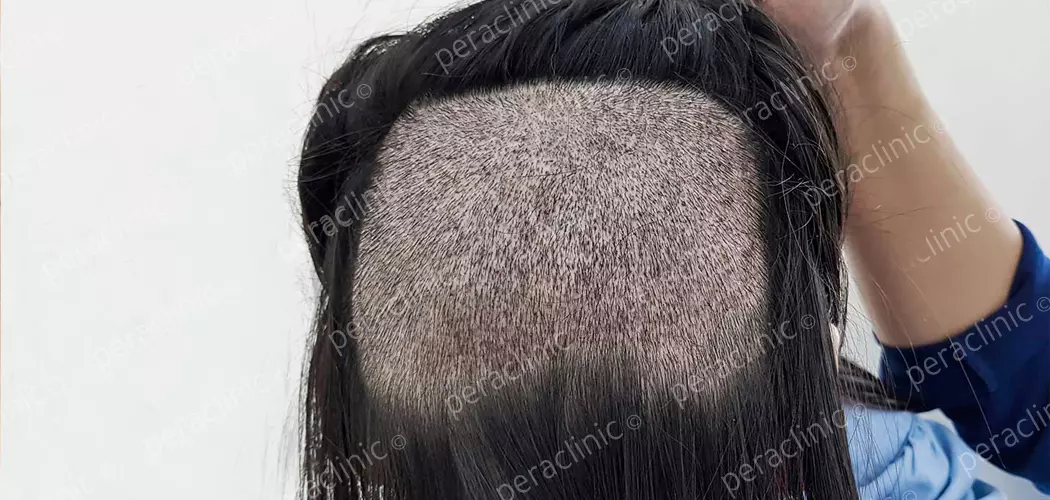 Greffe de cheveux chez les femmes